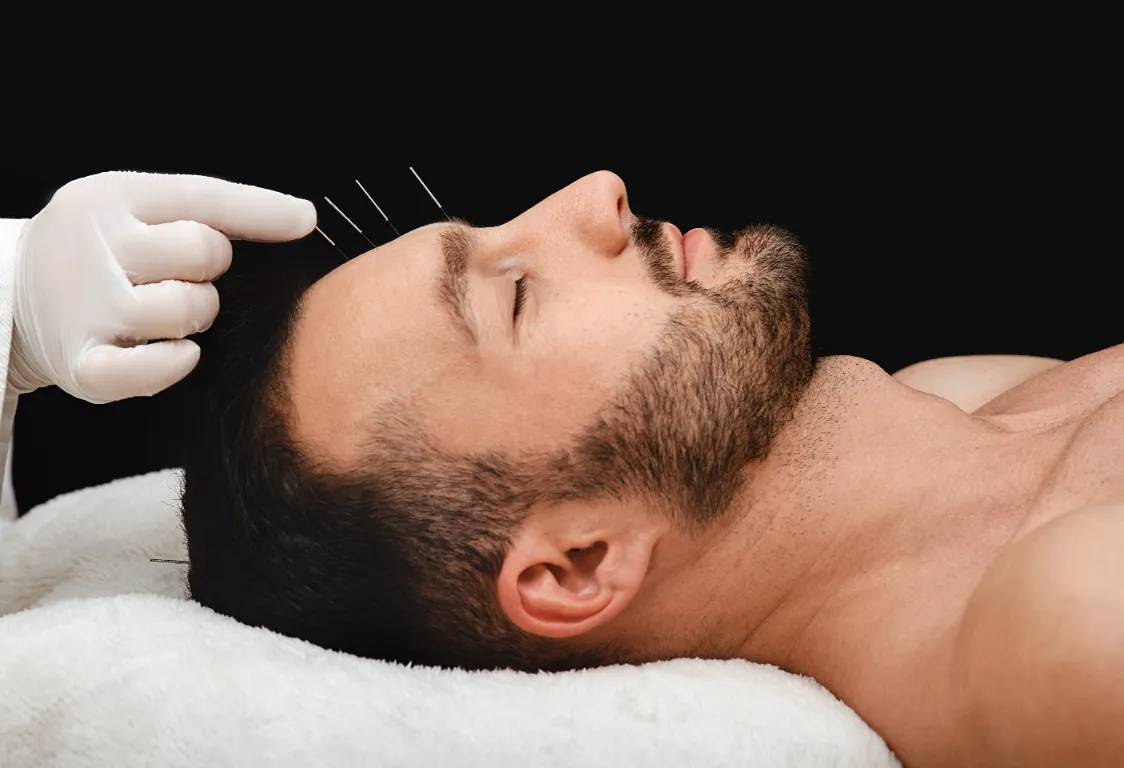 A massage therapist putting an acupuncture pins on the face on the male client.