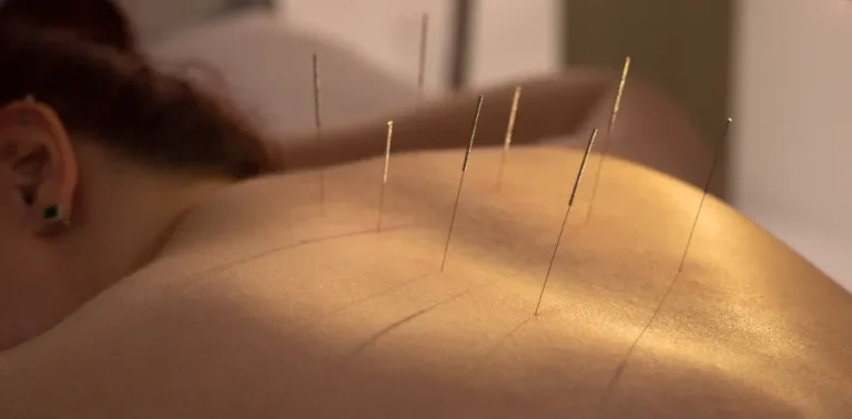 Acupuncture needles applied on a patient's back during therapy session.