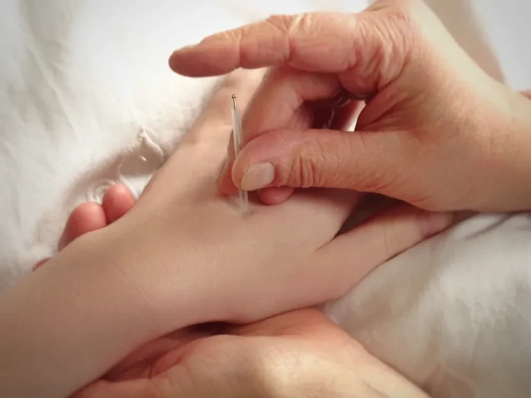 Therapist inserting acupuncture needle into patient's hand during treatment.